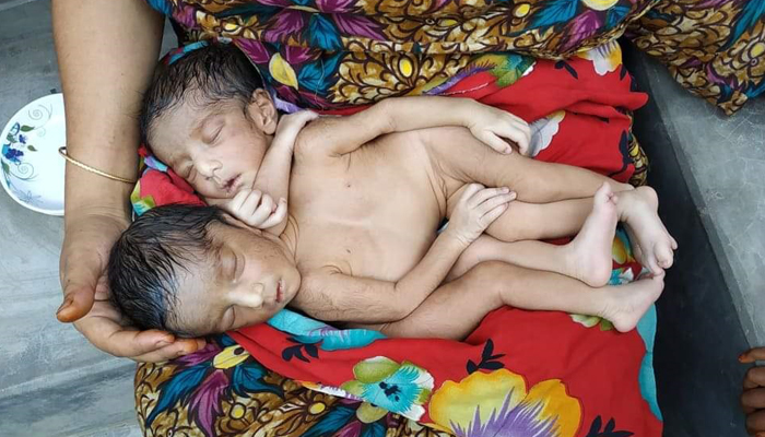 এক বুক নিয়ে জন্ম দুই শিশুকন্যার