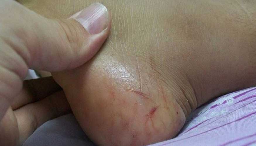 বছরে ৬ লাখ মানুষকে সাপ দংশন করে