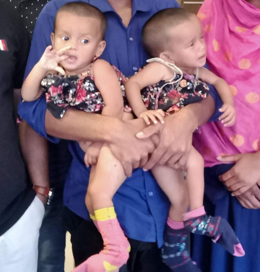সফল অস্ত্রোপচারে পৃথক জোড়া শিশু লাবিবা-লামিসা