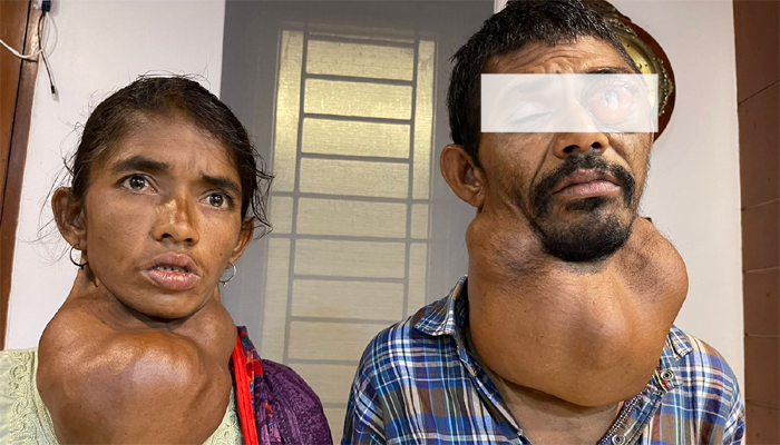 প্রধানমন্ত্রীর নির্দেশে টাঙ্গাইলের অসুস্থ ভাই-বোনের চিকিৎসা শুরু