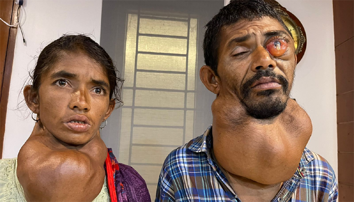 প্রধানমন্ত্রীর নির্দেশে টাঙ্গাইলের অসুস্থ ভাই-বোনের চিকিৎসা শুরু
