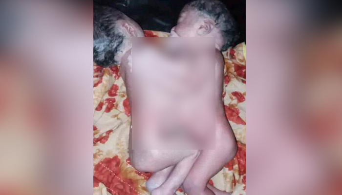 বরগুনায় জোড়া লাগানো যমজ শিশুর জন্ম