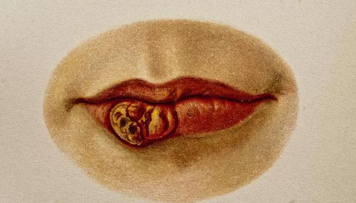 বিশ্বজুড়ে বাড়ছে যৌনরোগ সিফিলিস, লক্ষণগুলো কী