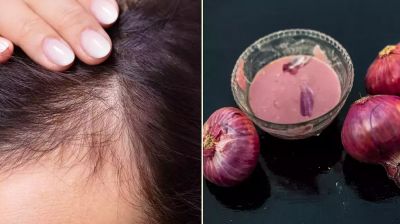 চুল গজাতে পেঁয়াজের রস, লাভ হচ্ছে না ক্ষতি?