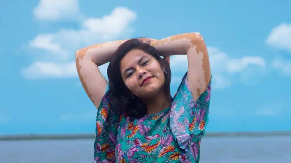 শ্বেতী রোগ কি ছোঁয়াচে ও নিরাময়যোগ্য?