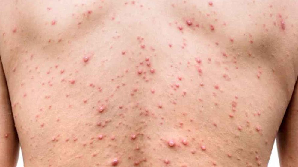 চব্বিশ ঘণ্টায় হাম উপসর্গে চারজনের মৃত্যু