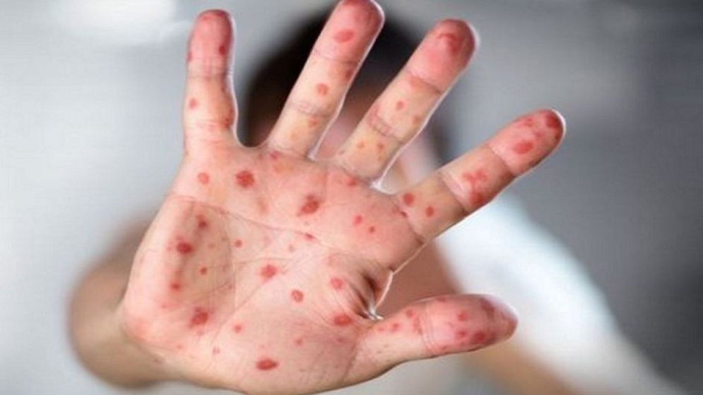 হামের উপসর্গ নিয়ে রাজশাহীতে ৫ শিশুর মৃত্যু