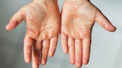 ২৪ ঘণ্টায় হামে ১২ শিশুর মৃত্যু, মোট মৃত্যু ১৩০