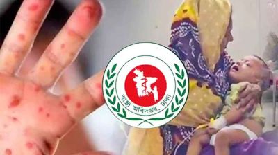 হাম ও উপসর্গে আরও ৫ শিশুর মৃত্যু