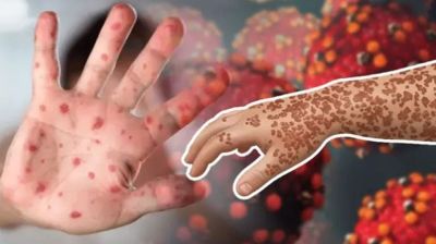 হাম ও উপসর্গে আরো ৭ জনের মৃত্যু