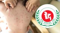 সারাদেশে হাম উপসর্গে আরো ৬ জনের মৃত্যু