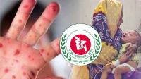 হাম পরিস্থিতি নিয়ে স্বাস্থ্য অধিদপ্তরের ব্রিফিং দুপুরে 