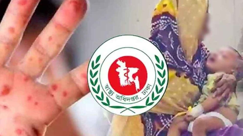 হামের উপসর্গে আরও ৫ শিশুর মৃত্যু