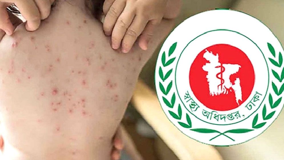 হাম উপসর্গে একদিনে আরো ৫ শিশুর মৃত্যু  