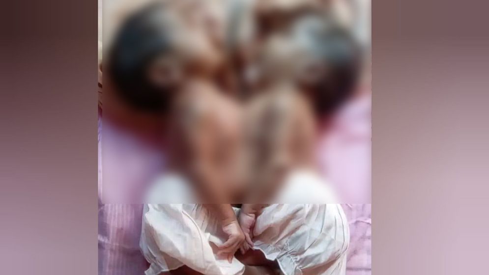 মারা গেল জোড়া লাগা দুই শিশু
