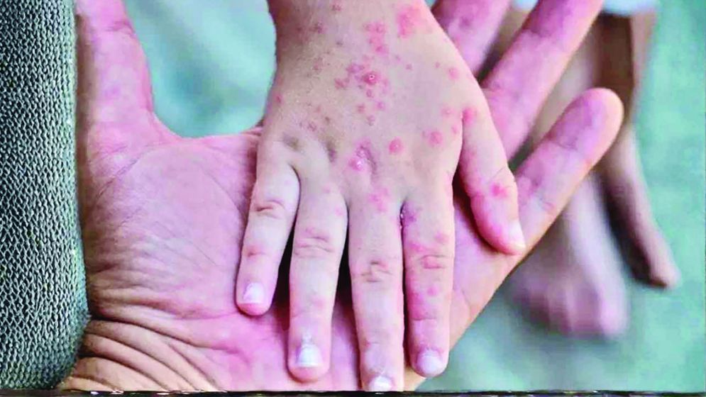 হামের টিকা অকার্যকর হওয়ার গুঞ্জন ভিত্তিহীন