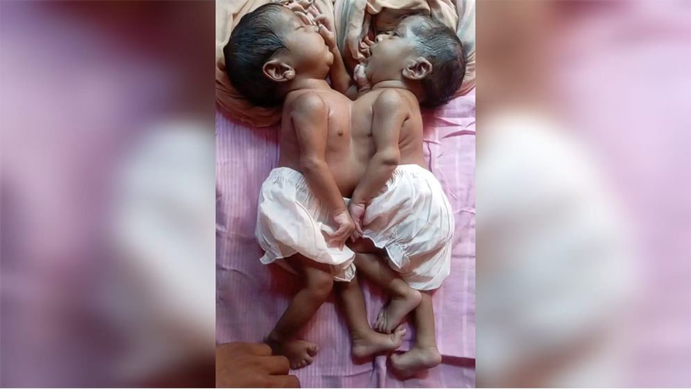 জোড়া লাগা দুই শিশুর চিকিৎসার দায়িত্ব নিয়েছে সরকার