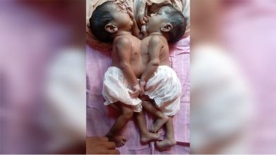 জোড়া লাগা দুই শিশুর চিকিৎসার দায়িত্ব নিয়েছে সরকার