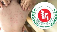হাম উপসর্গে একদিনে আরো ৫ শিশুর মৃত্যু  