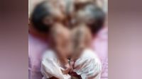 মারা গেল জোড়া লাগা দুই শিশু