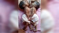 জোড়া লাগা দুই শিশুর চিকিৎসার দায়িত্ব নিয়েছে সরকার