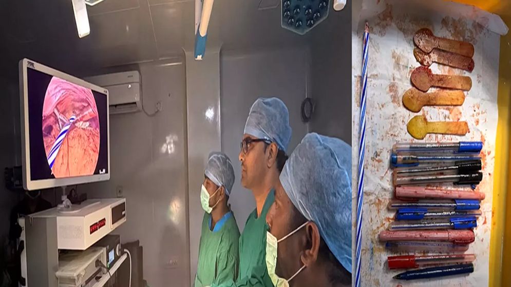 নারীর পেটে মিলল ১৪ কলম, ৫ কাঠের চামচ ও মোমবাতি  